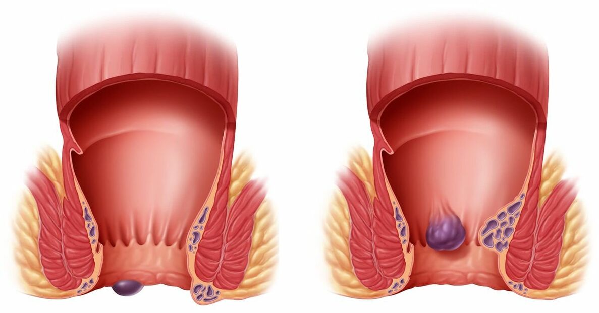 Gelarex aiuta con le emorroidi interne ed esterne